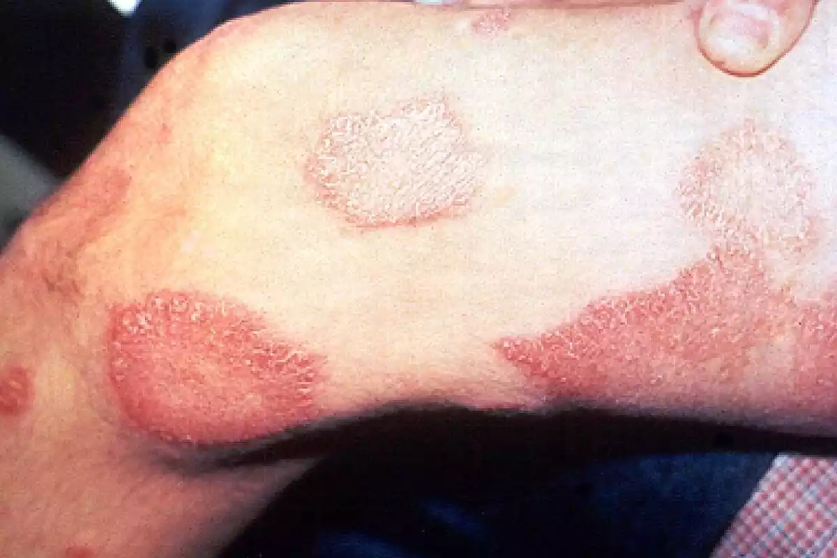 Imatge d'una cama amb les lesions cutànies provocades per la malaltia de la lepra