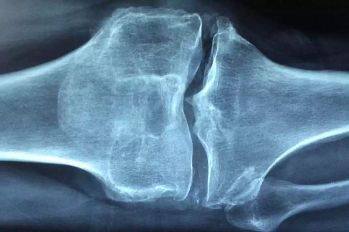Radiografia d'un genoll