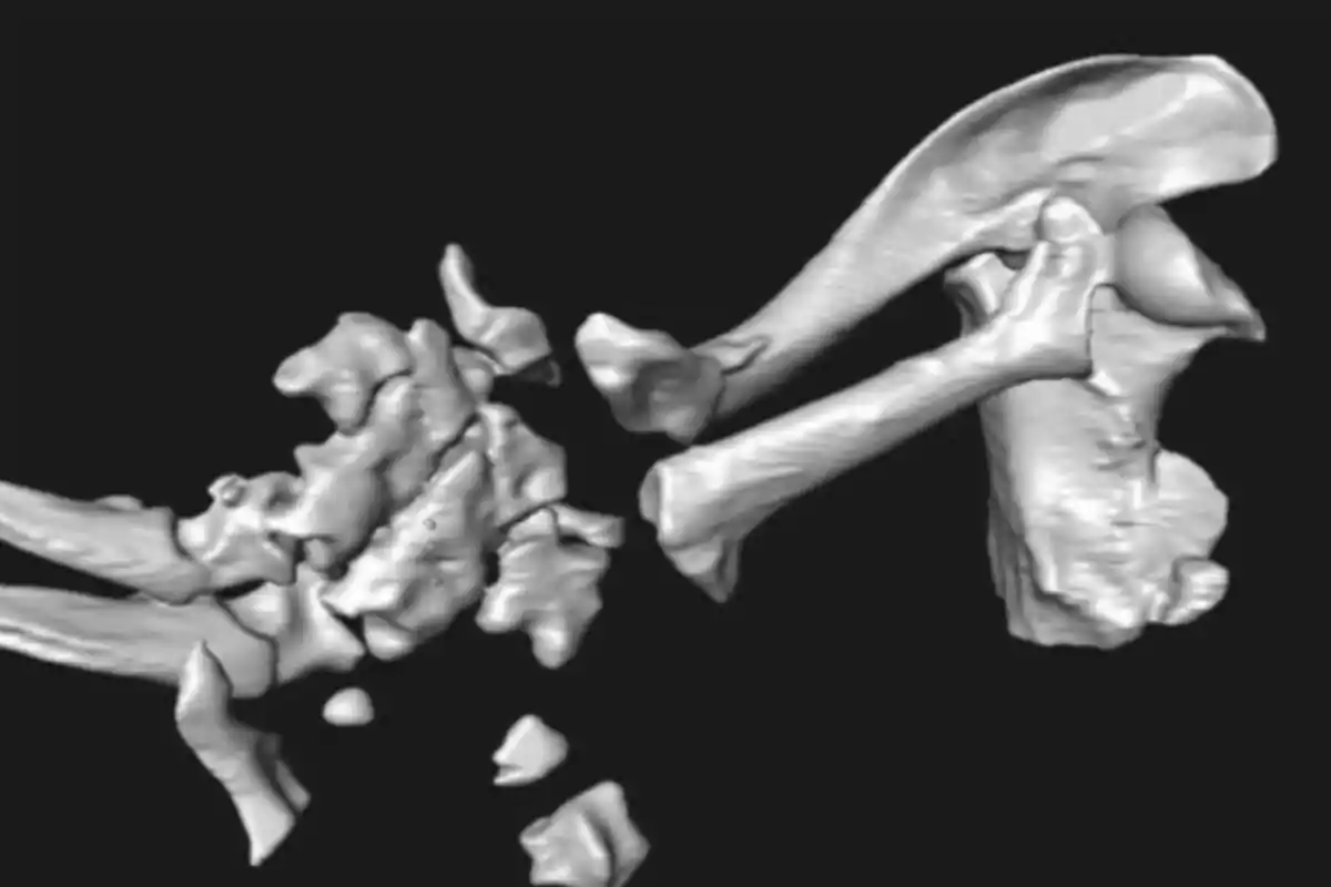 Reconstrucción tridimensional de huesos fracturados del hombro y la escápula sobre un fondo negro Reconstrucción tridimensional de huesos fracturados del hombro y la escápula sobre un fondo negro