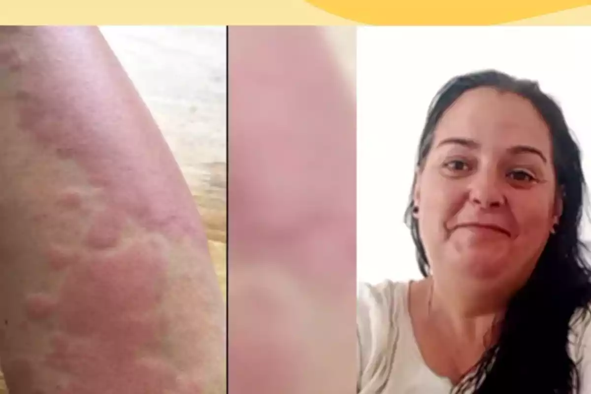 Brazo con ronchas rojas junto a una mujer de cabello oscuro y camiseta clara sonriendo.