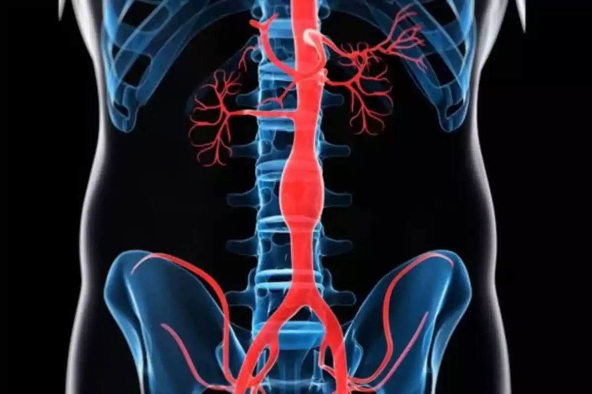 Ilustración médica que muestra una aneurisma en la aorta abdominal sobre un fondo negro Ilustración médica que muestra una aneurisma en la aorta abdominal sobre un fondo negro