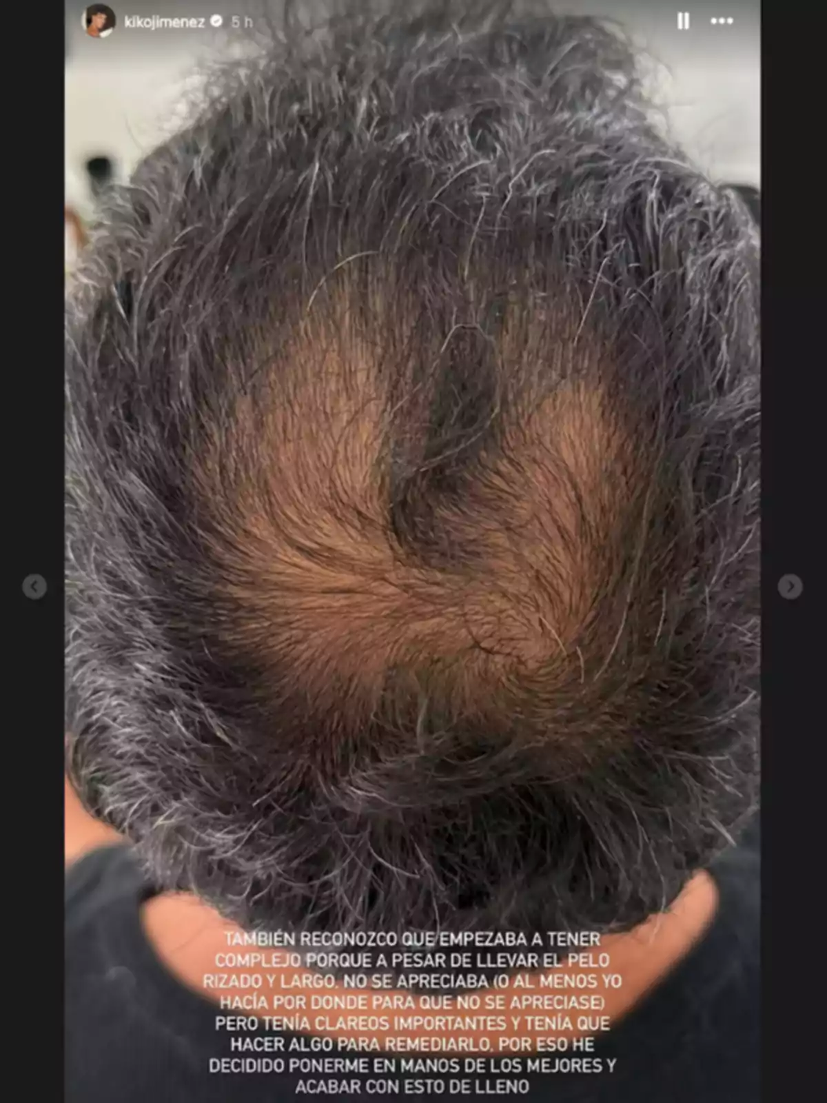 Kiko Jiménez visto desde arriba mostrando la coronilla con zonas de cabello ralo y canas, acompañada de un texto en la parte inferior sobre la preocupación por la pérdida de cabello.