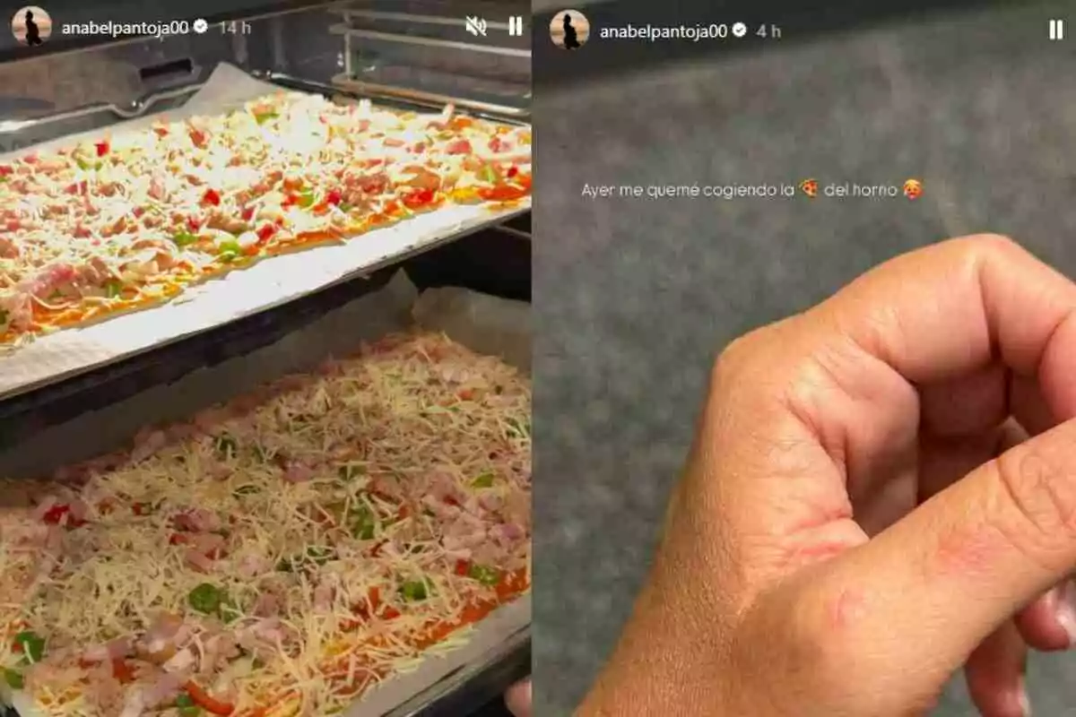 Una imatge mostra dues pizzes al forn i una mà amb una cremada. Una imatge mostra dues pizzes al forn i una mà amb una cremada.