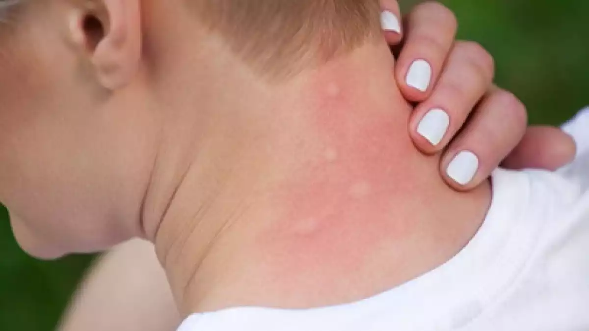 Imatge de diverses picades de mosquit al coll d'una persona